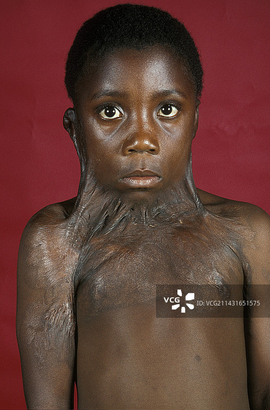 颈部挛缩图片素材