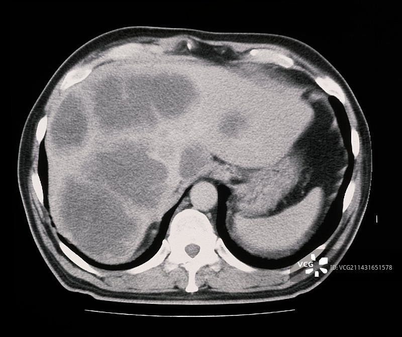 CT扫描显示肝癌图片素材