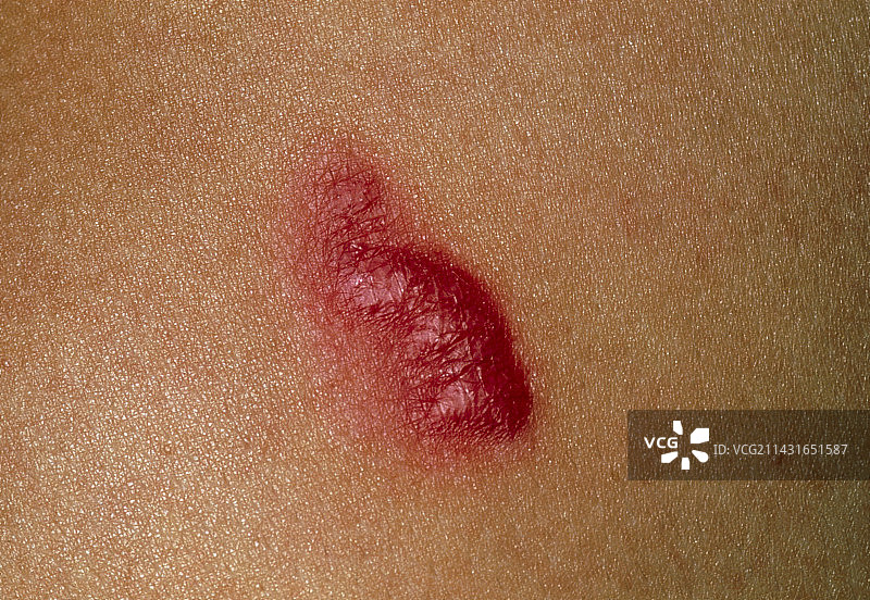 19岁女性的瘢痕疙瘩特写图片素材