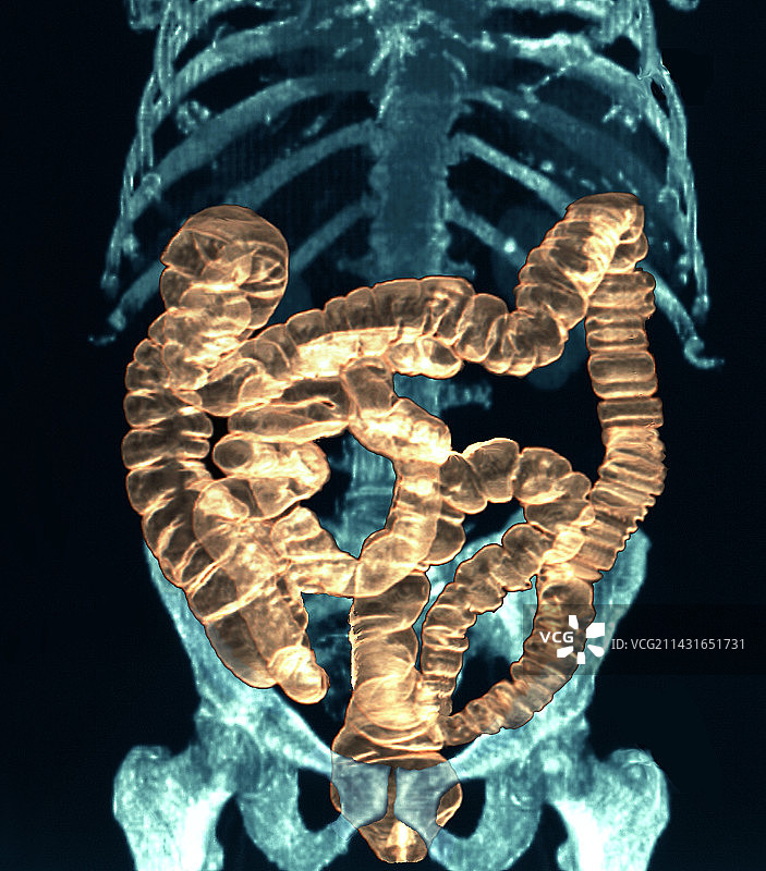 正常肠道3D CT扫描图片素材