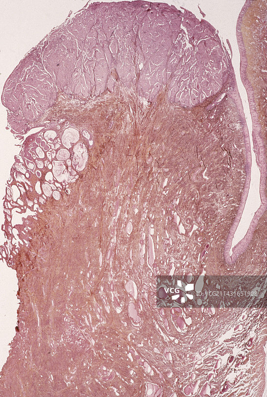 宫颈癌图片素材