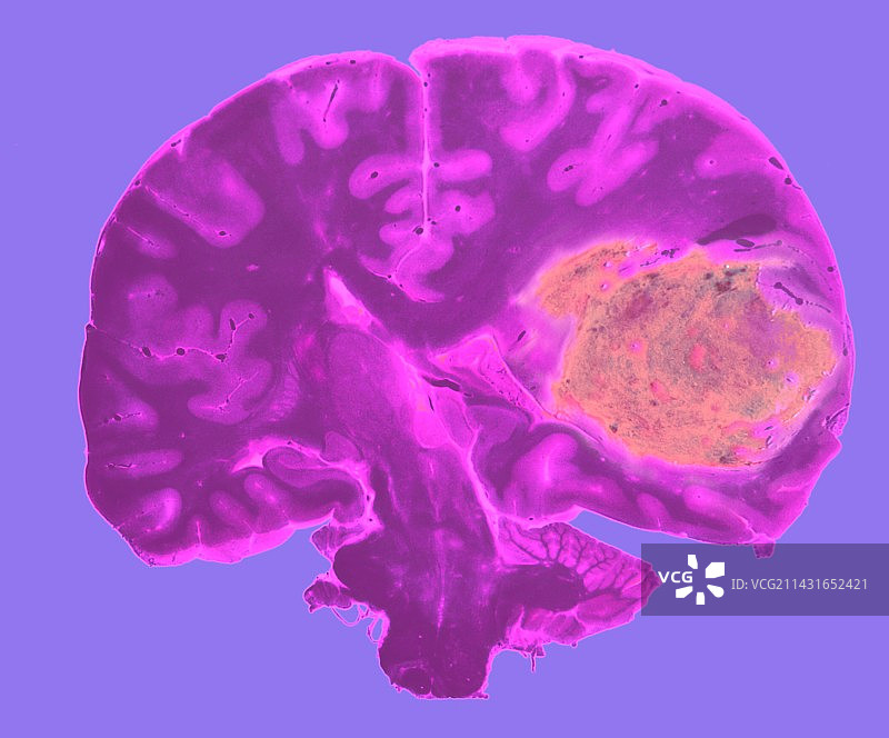 脑肿瘤图片素材