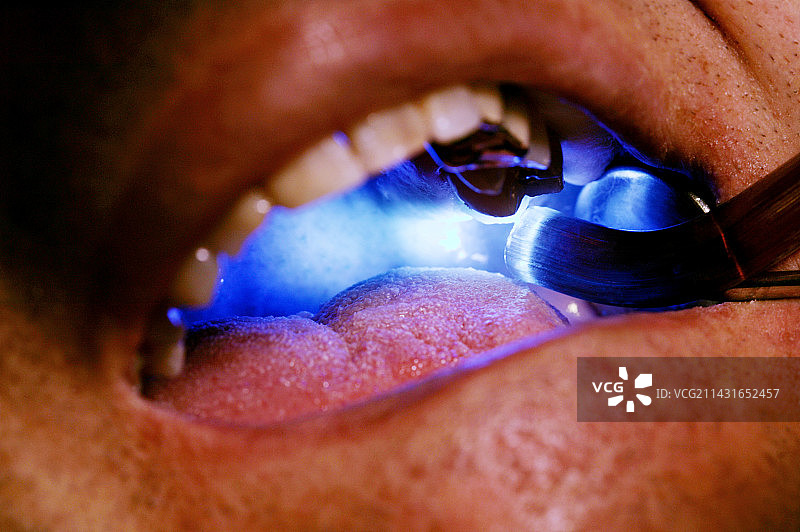 牙科治疗图片素材