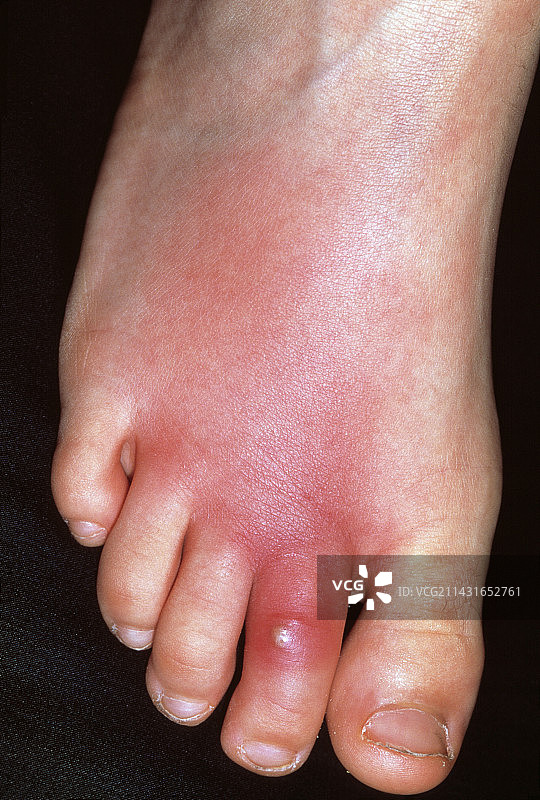 蜂窝组织炎图片素材