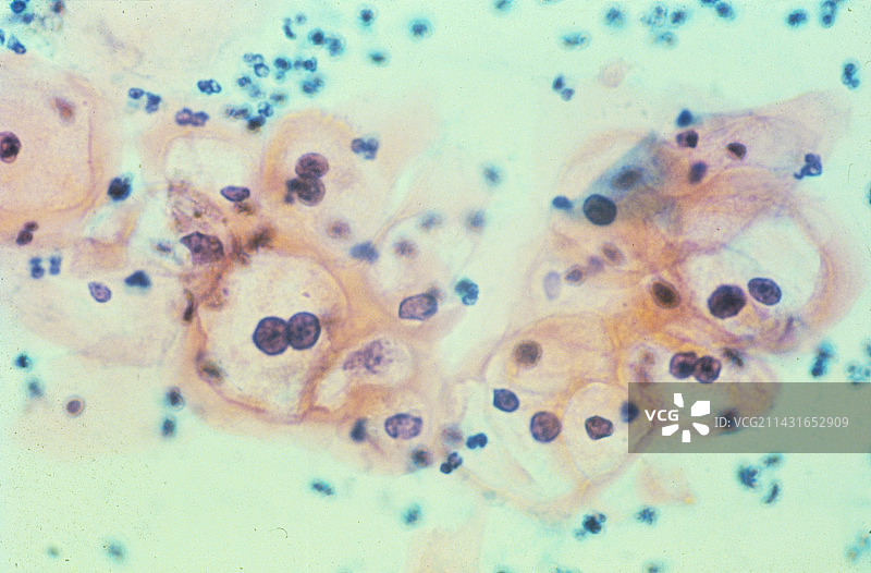 感染疣病毒的阴道涂片图片素材
