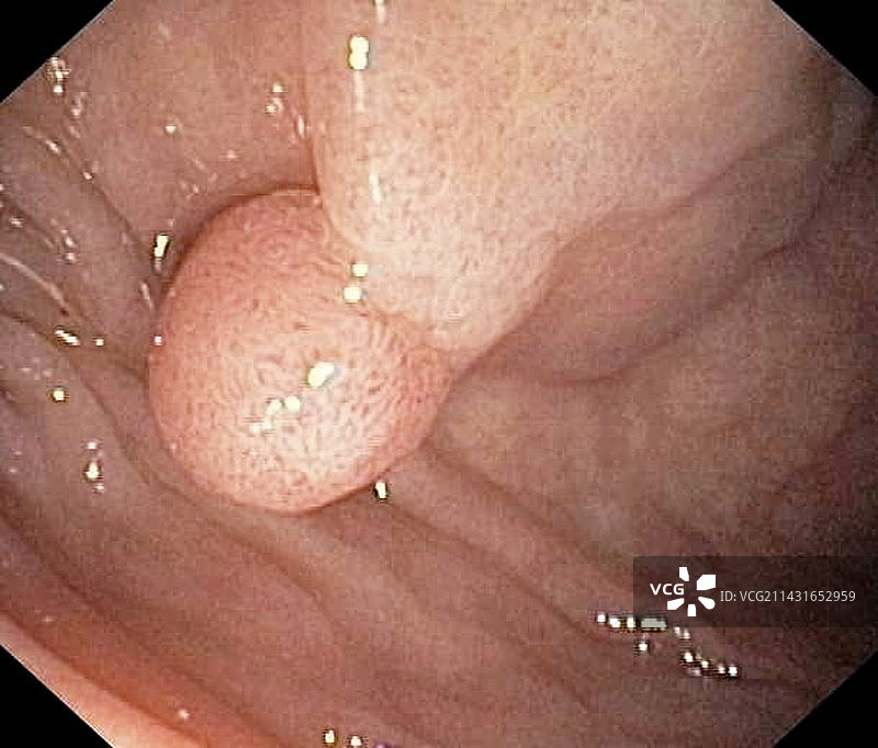 良性结肠增生图片素材