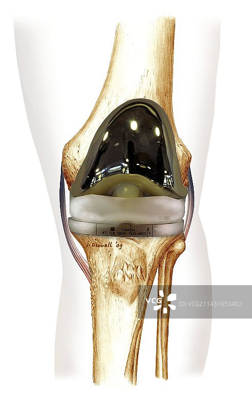 全膝关节置换术，艺术作品图片素材