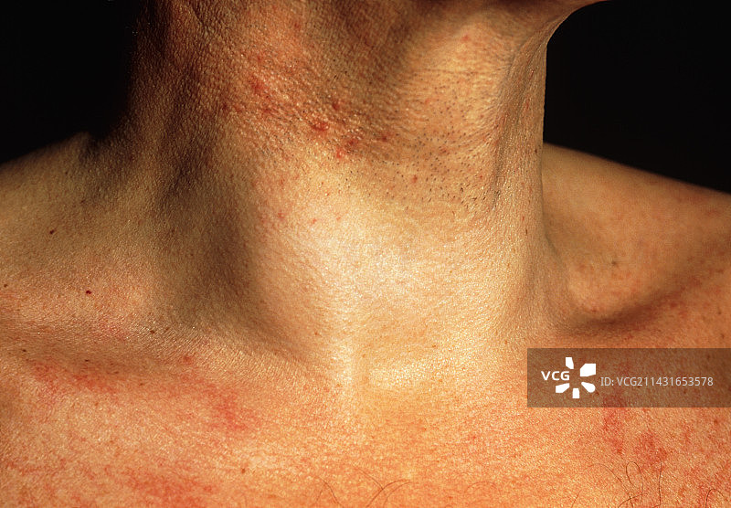 患有良性甲状腺囊肿的男子颈部肿胀图片素材