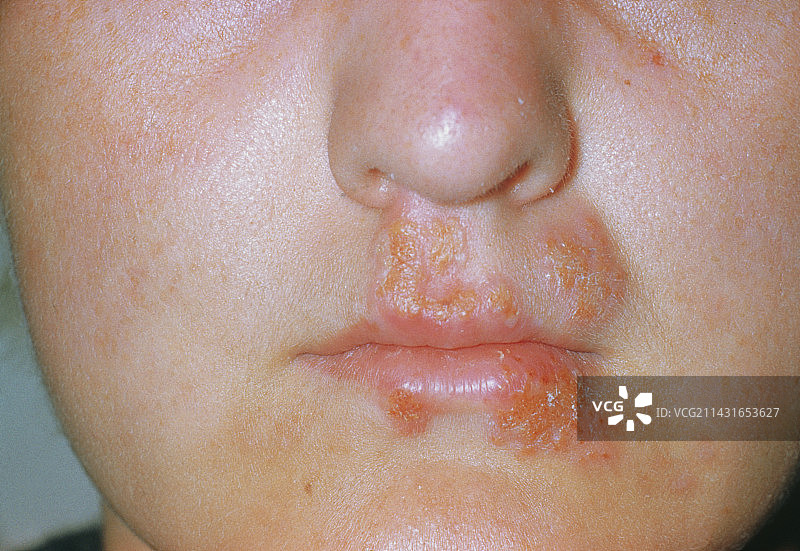 嘴唇和嘴巴上的单纯疱疹疮图片素材