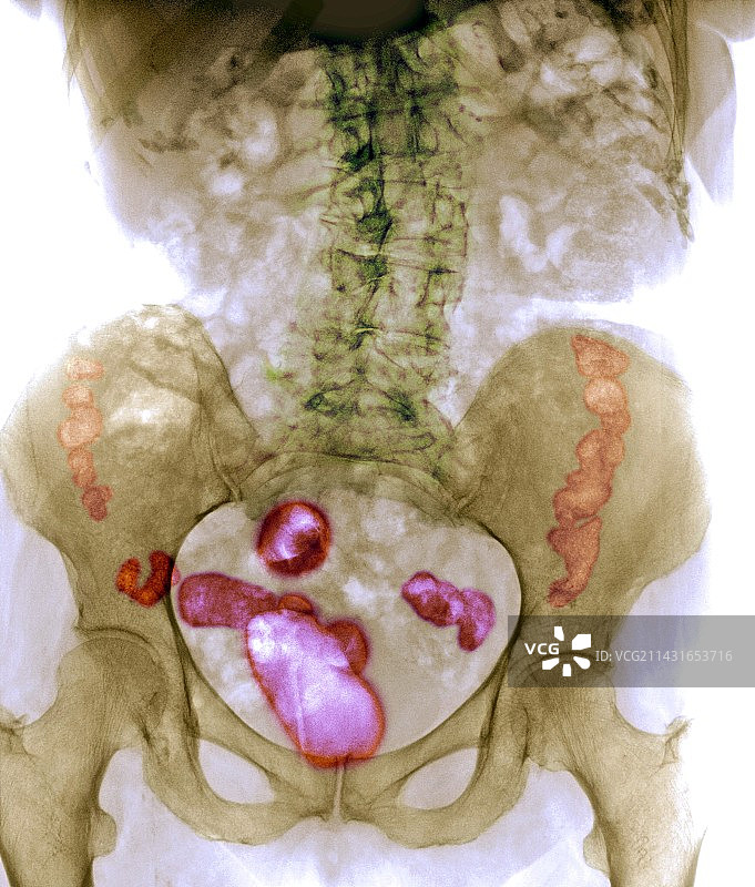 脊柱骨质疏松症X光片图片素材