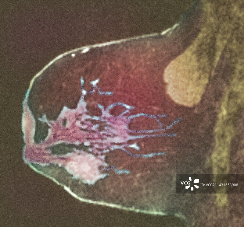 乳腺癌核磁共振扫描图片素材