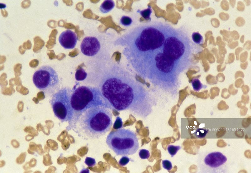 乳腺导管恶性癌细胞的光学显微镜图片素材