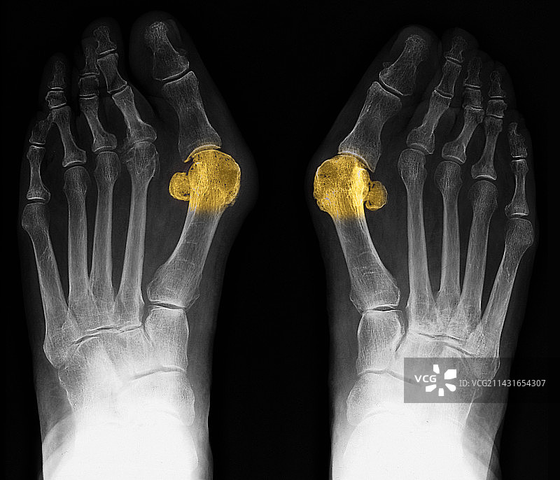 拇囊炎X光片图片素材