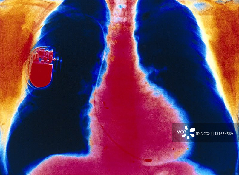植入胸部的起搏器的彩色X光片图片素材