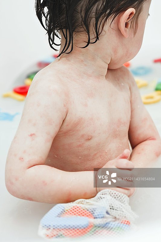 患有湿疹的男孩图片素材