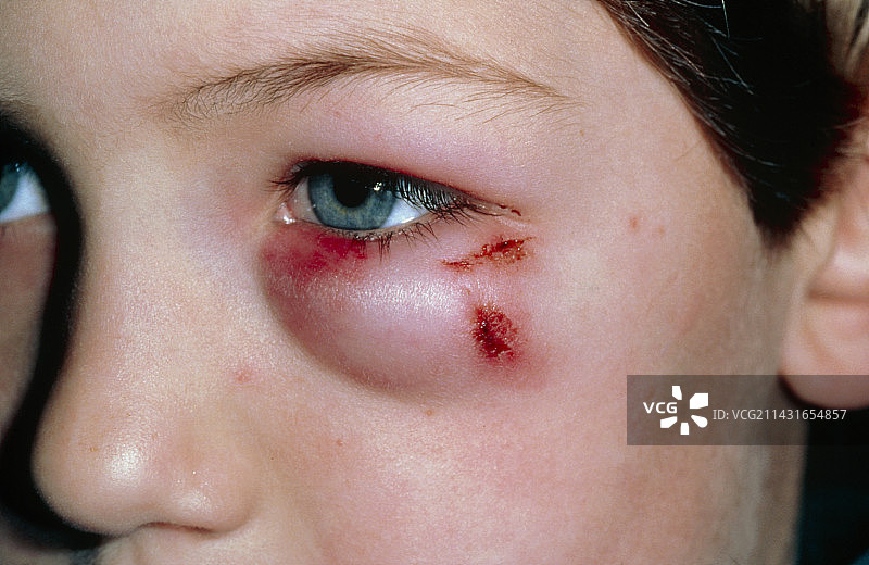 眼球外伤；眶周水肿图片素材