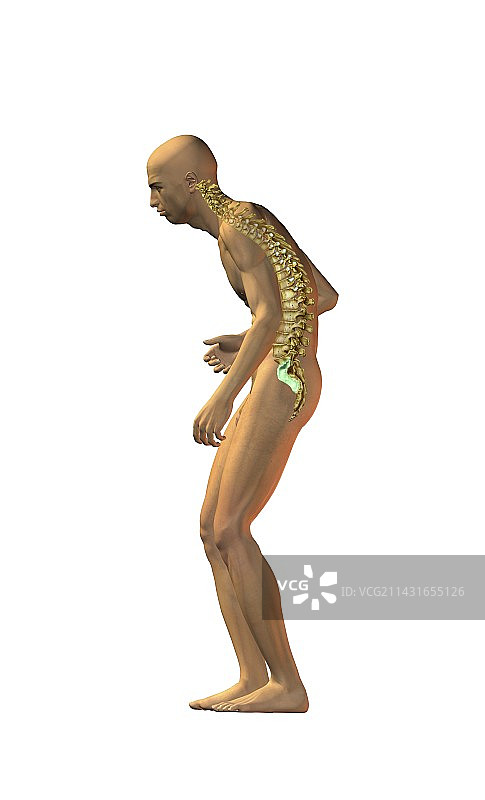 脊柱疾病，医学插图图片素材