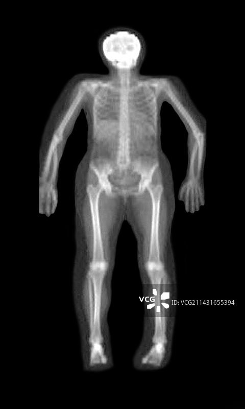 骨密度扫描图片素材