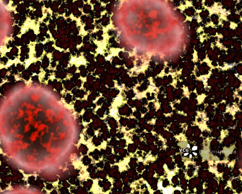 克雅氏病变异脑部图片素材