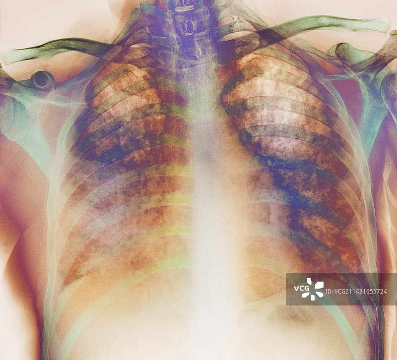 肺炎X光片图片素材