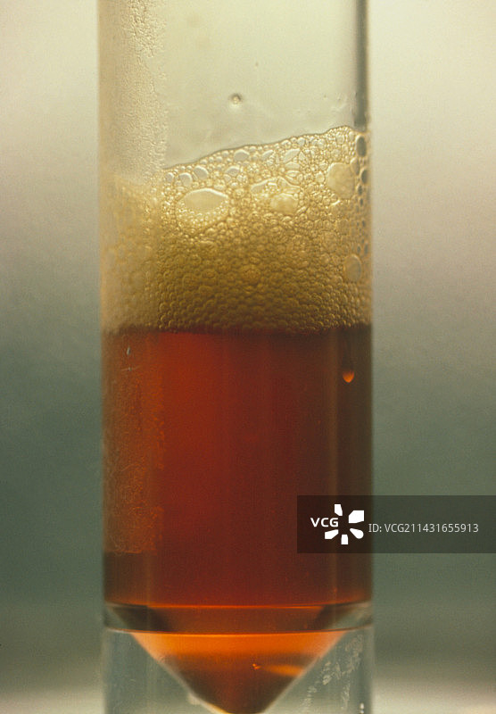 因黄疸引起的黄色尿液图片素材