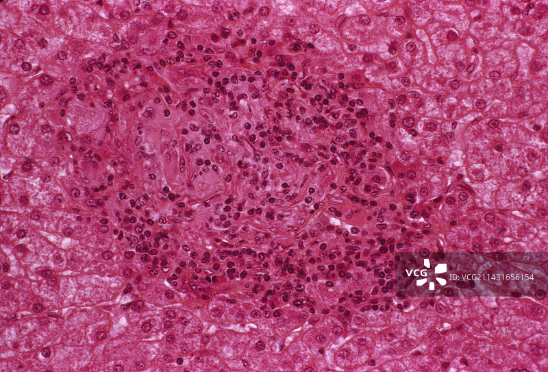 肝硬化图片素材