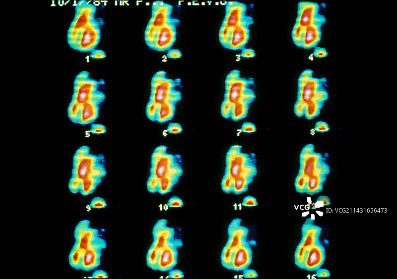 心脏血流的伽马扫描系列图片素材