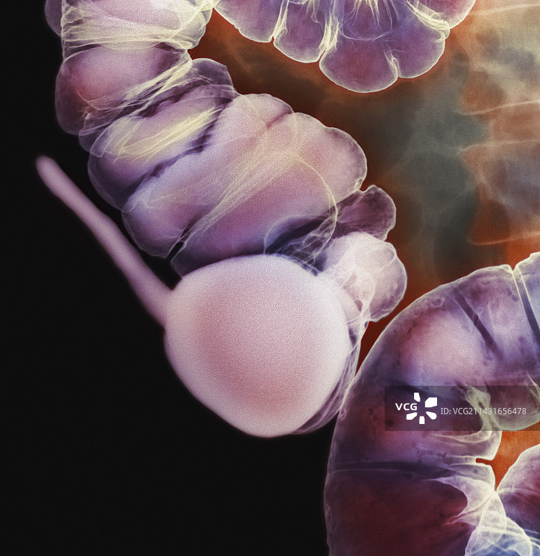 阑尾x光片图片素材