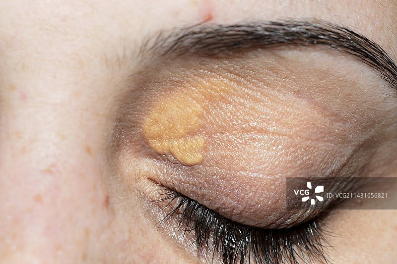 眼睑上的睑黄瘤图片素材