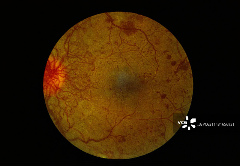 糖尿病引起的视网膜损伤图片素材