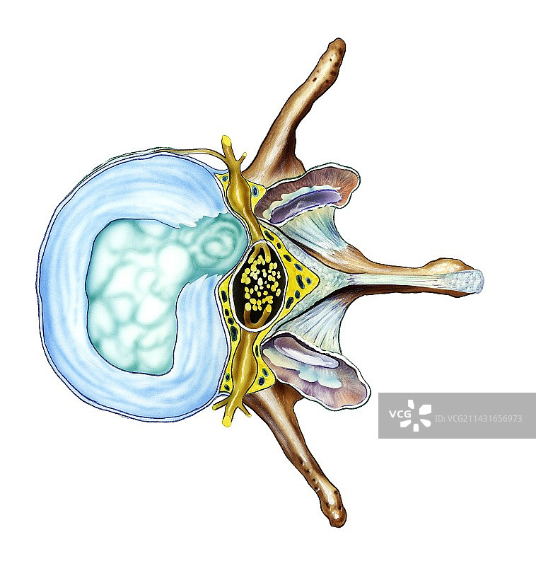 椎间盘滑落图片素材