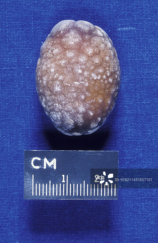 胆结石图片素材