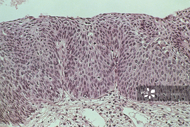 III级宫颈上皮内瘤变的LM显微图图片素材