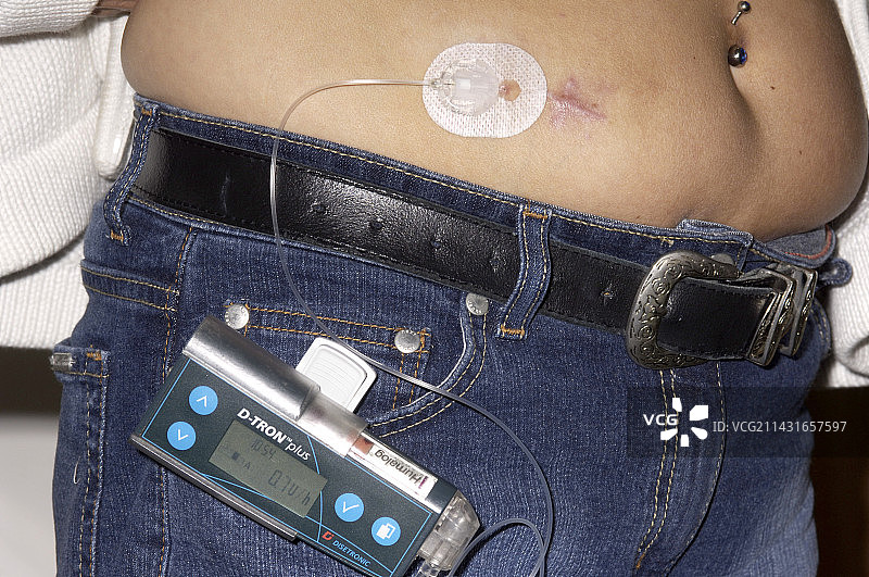 胰岛素泵图片素材