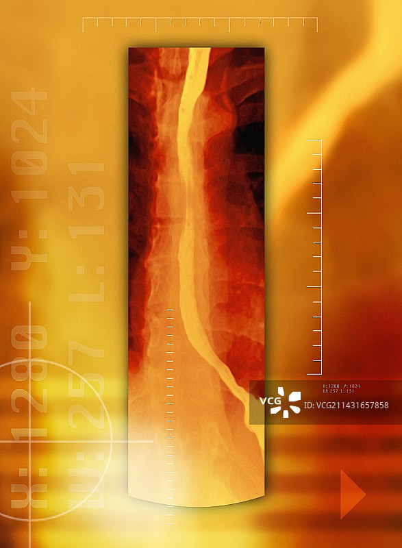 食道X光片图片素材