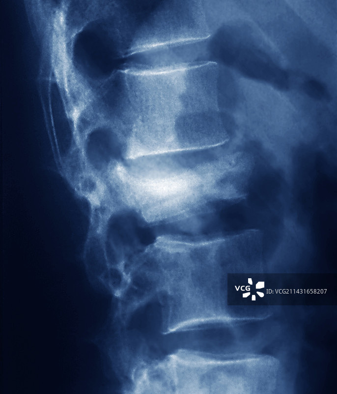 骨质疏松症X光片图片素材