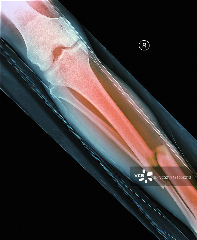 腿骨骨折X光片图片素材