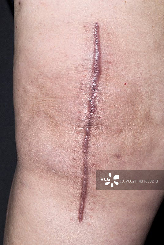 瘢痕疙瘩图片素材