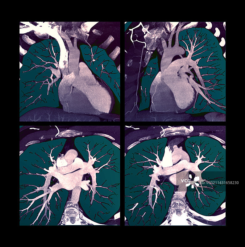 心脏CT扫描图片素材