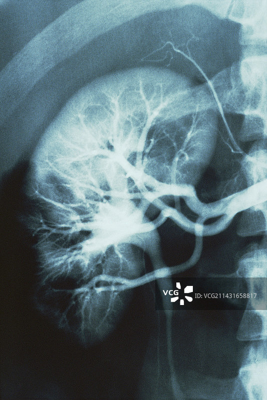 肾脏血管X光片图片素材
