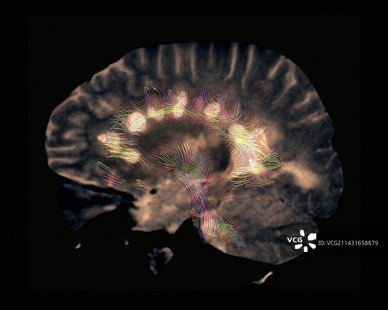 多发性硬化症MRI扫描图片素材