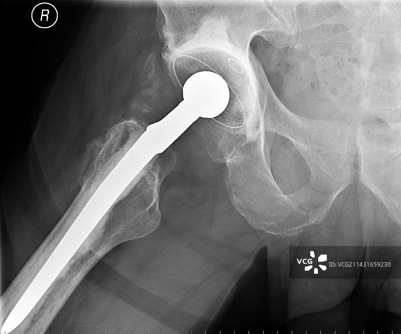 全髋关节置换X光片图片素材
