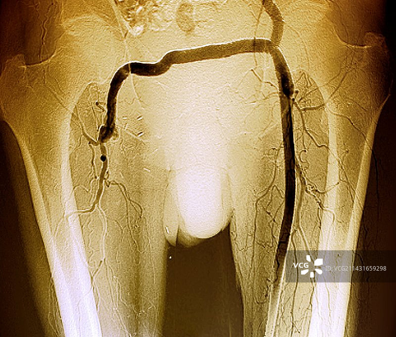动脉搭桥手术血管造影图片素材