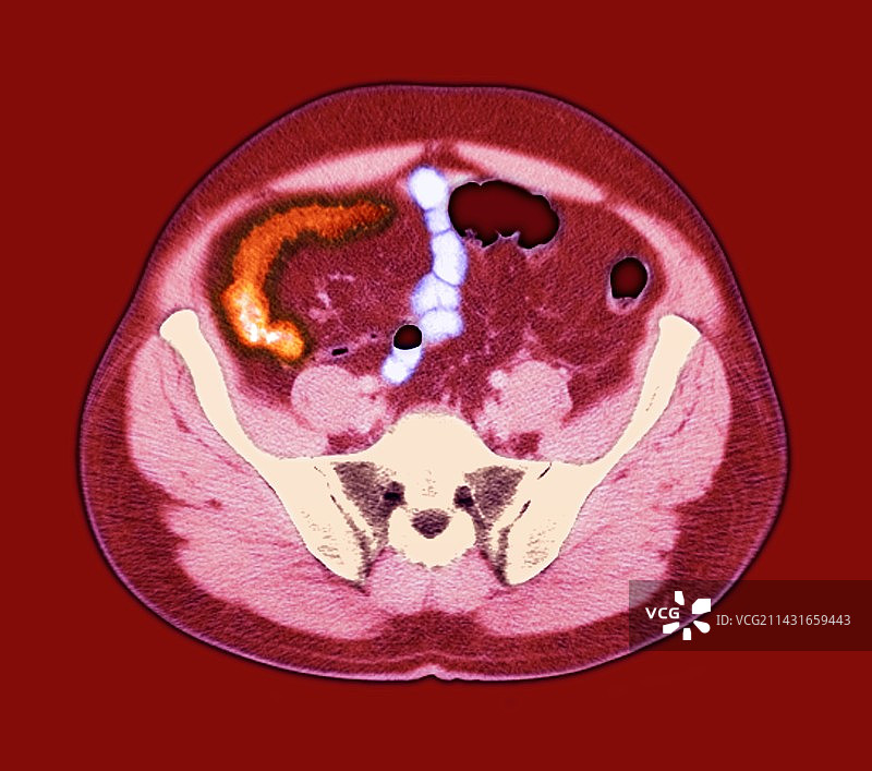 克罗恩病核磁共振成像图片素材