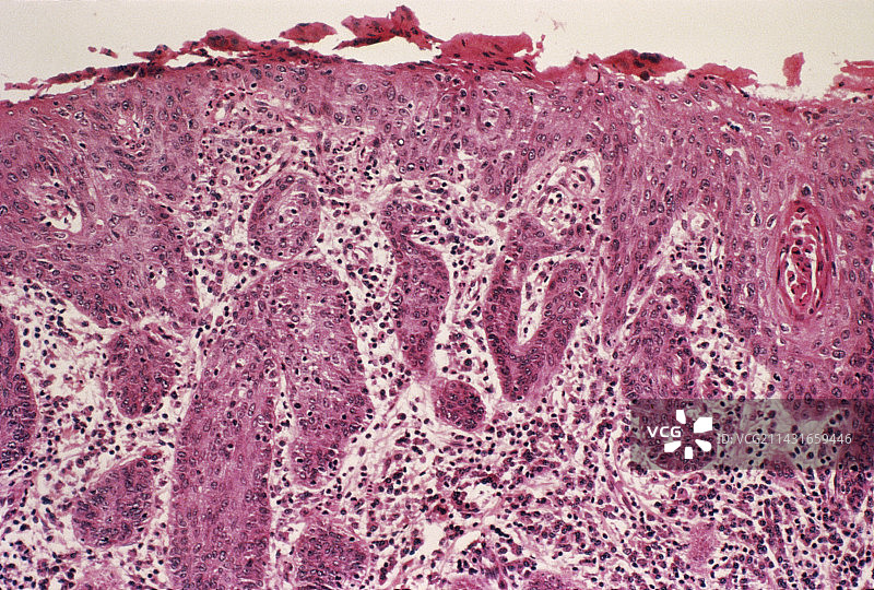 声带癌图片素材