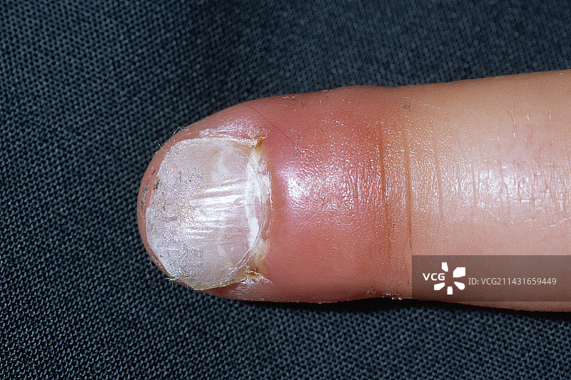 手指被压伤图片素材