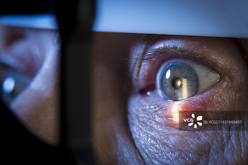 裂隙灯眼科检查图片素材