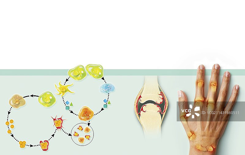 类风湿性关节炎机制医学插图图片素材