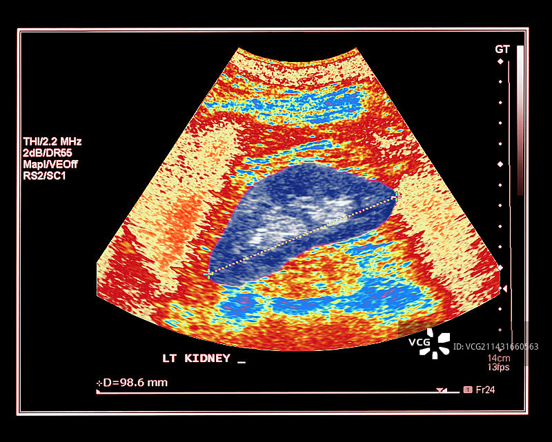 测量的健康肾脏超声波扫描图片素材