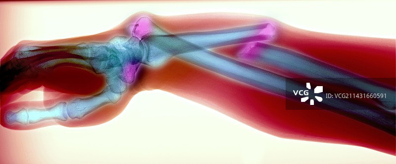 手臂骨折和手腕脱臼图片素材